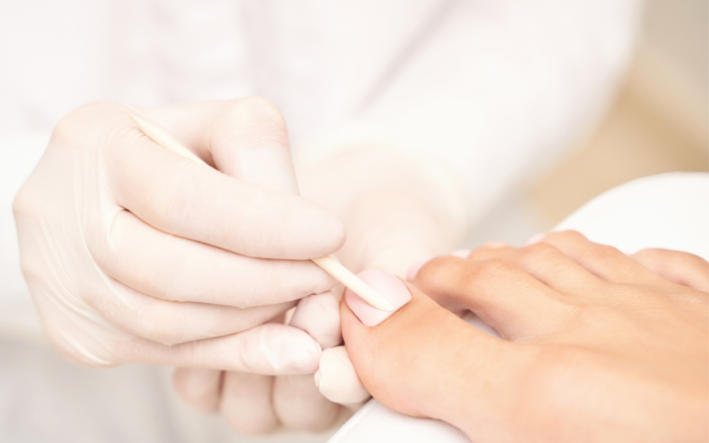 Un especialista tratandole la uña con un hisopo a una persona.